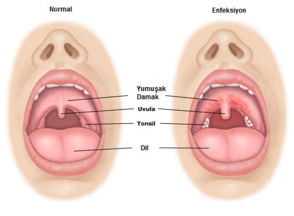 Çocuk Bademcik (Tonsil)