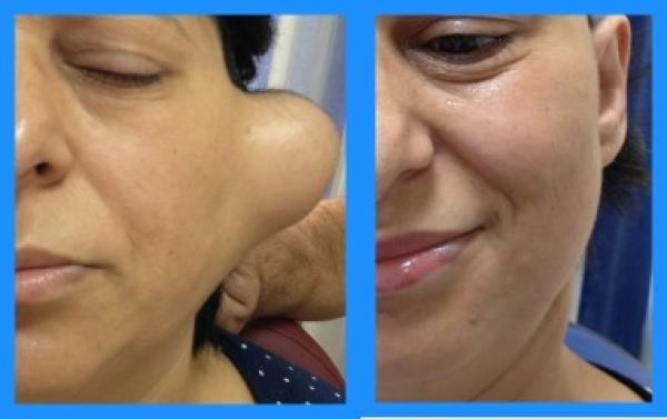 TÜKRÜK BEZİ TÜMÖRLERİ